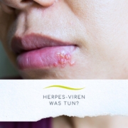 Frau mit Lippen und Herpes-Viren
